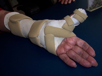 Splint Designs Loya Hand Center